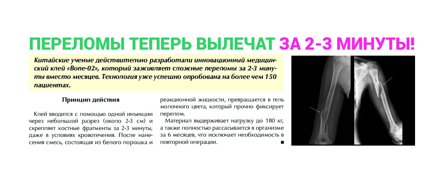 Fractures_article